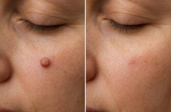 Папилломы под контролем: как удалить и не пожалеть потом